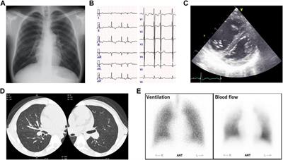 Frontiers Novel AGL variants in a patient with glycogen storage